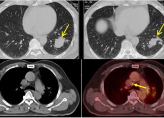Hình ảnh khối u ở phổi bệnh nhân V. (2 ảnh trên) và hình ảnh khối u thu nhỏ sau điều trị